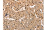 The image on the left is immunohistochemistry of paraffin-embedded Human liver cancer tissue using CSB-PA313566(ATG12 Antibody) at dilution 1/70, on the right is treated with fusion protein. (Original magnification: 