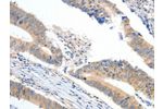 The image on the left is immunohistochemistry of paraffin-embedded Human colon cancer tissue using CSB-PA318254(APOB Antibody) at dilution 1/10, on the right is treated with synthetic peptide. (Original magnification: 