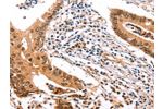 The image on the left is immunohistochemistry of paraffin-embedded Human colon cancer tissue using CSB-PA325213(ERBB3 Antibody) at dilution 1/35, on the right is treated with fusion protein. (Original magnification: 