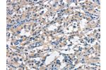 The image on the left is immunohistochemistry of paraffin-embedded Human thyroid cancer tissue using CSB-PA325565(ANAPC1 Antibody) at dilution 1/30, on the right is treated with synthetic peptide. (Original magnification: 