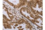The image on the left is immunohistochemistry of paraffin-embedded Human gastic cancer tissue using CSB-PA327117(CFLAR Antibody) at dilution 1/20, on the right is treated with synthetic peptide. (Original magnification: 