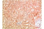 Immunohistochemical analysis of paraffin-embedded Human Hepatocarcinoma Tissue using ATG5 Rabbit pAb diluted at 1:200