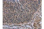 The image on the left is immunohistochemistry of paraffin-embedded Human lung cancer tissue using CSB-PA335882(AVEN Antibody) at dilution 1/30, on the right is treated with synthetic peptide. (Original magnification: 