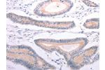 The image on the left is immunohistochemistry of paraffin-embedded Human colon cancer tissue using CSB-PA337817(ANGPTL2 Antibody) at dilution 1/20, on the right is treated with synthetic peptide. (Original magnification: 