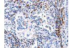 The image on the left is immunohistochemistry of paraffin-embedded Human lung cancer tissue using CSB-PA338014(DOK3 Antibody) at dilution 1/25, on the right is treated with fusion protein. (Original magnification: 