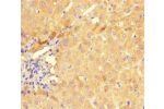 Immunohistochemistry of paraffin-embedded human liver cancer using CSB-PA339756HA01HU at dilution of 1:100