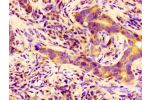 Immunohistochemistry of paraffin-embedded human pancreatic cancer using CSB-PA341920LA01HU at dilution of 1:100