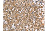 The image on the left is immunohistochemistry of paraffin-embedded Human thyroid cancer tissue using CSB-PA343705(DDX53 Antibody) at dilution 1/40, on the right is treated with fusion protein. (Original magnification: 