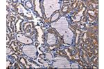 The image on the left is immunohistochemistry of paraffin-embedded Human thyroid cancer tissue using CSB-PA343762(DRD1 Antibody) at dilution 1/50, on the right is treated with synthetic peptide. (Original magnification: 