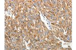 The image on the left is immunohistochemistry of paraffin-embedded Human ovarian cancer tissue using CSB-PA345280(COL4A3 Antibody) at dilution 1/20, on the right is treated with synthetic peptide. (Original magnification: 
