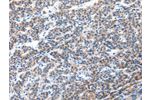 The image on the left is immunohistochemistry of paraffin-embedded Human liver cancer tissue using CSB-PA346332(CFC1 Antibody) at dilution 1/30, on the right is treated with synthetic peptide. (Original magnification: 