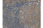 The image on the left is immunohistochemistry of paraffin-embedded Human tonsil tissue using CSB-PA347049(CLIC1 Antibody) at dilution 1/30, on the right is treated with fusion protein. (Original magnification: 