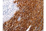 The image on the left is immunohistochemistry of paraffin-embedded Human cervical cancer tissue using CSB-PA354357(ABCA4 Antibody) at dilution 1/25, on the right is treated with synthetic peptide. (Original magnification: 