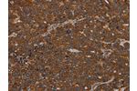The image on the left is immunohistochemistry of paraffin-embedded Human ovarian cancer tissue using CSB-PA356766(GDF2 Antibody) at dilution 1/40, on the right is treated with synthetic peptide. (Original magnification: 