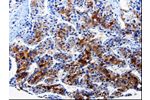 The image on the left is immunohistochemistry of paraffin-embedded Human liver cancer tissue using CSB-PA358768(FTH1 Antibody) at dilution 1/10, on the right is treated with fusion protein. (Original magnification: 