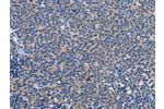 The image on the left is immunohistochemistry of paraffin-embedded Human Lymphoma tissue using CSB-PA358929(CTSC Antibody) at dilution 1/25, on the right is treated with synthetic peptide. (Original magnification: 