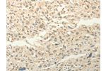The image on the left is immunohistochemistry of paraffin-embedded Human esophagus cancer tissue using CSB-PA360153(FZD8 Antibody) at dilution 1/50, on the right is treated with synthetic peptide. (Original magnification: 