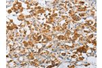 The image on the left is immunohistochemistry of paraffin-embedded Human thyroid cancer tissue using CSB-PA364661(ARHGEF9 Antibody) at dilution 1/50, on the right is treated with fusion protein. (Original magnification: 