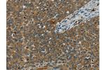 The image on the left is immunohistochemistry of paraffin-embedded Human cervical cancer tissue using CSB-PA365158(E2F6 Antibody) at dilution 1/60, on the right is treated with fusion protein. (Original magnification: 