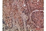 Immunohistochemical analysis of paraffin-embedded human-lung-cancer, antibody was diluted at 1:200