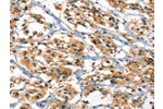 The image on the left is immunohistochemistry of paraffin-embedded Human thyroid cancer tissue using CSB-PA366900(DEFA1/3 Antibody) at dilution 1/30, on the right is treated with synthetic peptide. (Original magnification: 