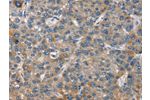 The image on the left is immunohistochemistry of paraffin-embedded Human liver cancer tissue using CSB-PA377075(GINS1 Antibody) at dilution 1/25, on the right is treated with synthetic peptide. (Original magnification: 
