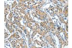 The image on the left is immunohistochemistry of paraffin-embedded Human lung cancer tissue using CSB-PA378255(CKAP4 Antibody) at dilution 1/30, on the right is treated with synthetic peptide. (Original magnification: 