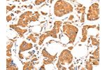The image on the left is immunohistochemistry of paraffin-embedded Human breast cancer tissue using CSB-PA383927(ACSM5 Antibody) at dilution 1/20, on the right is treated with fusion protein. (Original magnification: 