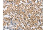 The image on the left is immunohistochemistry of paraffin-embedded Human thyroid cancer tissue using CSB-PA390581(BCL10 Antibody) at dilution 1/40, on the right is treated with fusion protein. (Original magnification: 