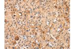 The image on the left is immunohistochemistry of paraffin-embedded Human liver cancer tissue using CSB-PA390632(AQP7 Antibody) at dilution 1/20, on the right is treated with synthetic peptide. (Original magnification: 