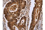 The image on the left is immunohistochemistry of paraffin-embedded Human colon cancer tissue using CSB-PA399518(EXTL3 Antibody) at dilution 1/30, on the right is treated with fusion protein. (Original magnification: 