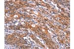 The image on the left is immunohistochemistry of paraffin-embedded Human gastic cancer tissue using CSB-PA400855(FEM1A Antibody) at dilution 1/20, on the right is treated with synthetic peptide. (Original magnification: 