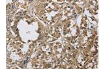 The image on the left is immunohistochemistry of paraffin-embedded Human thyroid cancer tissue using CSB-PA401715(DSG2 Antibody) at dilution 1/70, on the right is treated with fusion protein. (Original magnification: 