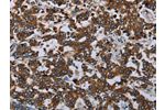 The image on the left is immunohistochemistry of paraffin-embedded Human liver cancer tissue using CSB-PA403881(AVEN Antibody) at dilution 1/20, on the right is treated with synthetic peptide. (Original magnification: 