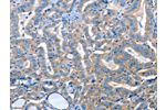 The image on the left is immunohistochemistry of paraffin-embedded Human thyroid cancer tissue using CSB-PA408174(ADH4 Antibody) at dilution 1/25, on the right is treated with fusion protein. (Original magnification: 