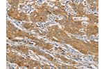 The image on the left is immunohistochemistry of paraffin-embedded Human gastic cancer tissue using CSB-PA409894(ARHGEF7 Antibody) at dilution 1/40, on the right is treated with fusion protein. (Original magnification: 