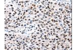 The image is immunohistochemistry of paraffin-embedded Human renal cancer tissue using CSB-PA411017(AQP2 Antibody) at dilution 1/50. (Original magnification: 200)