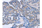 The image on the left is immunohistochemistry of paraffin-embedded Human thyroid cancer tissue using CSB-PA418436(AMACR Antibody) at dilution 1/30, on the right is treated with fusion protein. (Original magnification: 