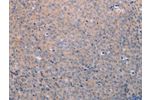The image on the left is immunohistochemistry of paraffin-embedded Human cervical cancer tissue using CSB-PA432470(ANKRD26 Antibody) at dilution 1/25, on the right is treated with synthetic peptide. (Original magnification: 