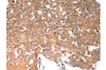 The image on the left is immunohistochemistry of paraffin-embedded Human breast cancer tissue using CSB-PA434737(BGLAP Antibody) at dilution 1/40, on the right is treated with synthetic peptide. (Original magnification: 