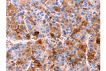 The image on the left is immunohistochemistry of paraffin-embedded Human liver cancer tissue using CSB-PA436972(ERN2 Antibody) at dilution 1/40, on the right is treated with synthetic peptide. (Original magnification: 