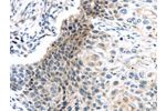 The image on the left is immunohistochemistry of paraffin-embedded Human esophagus cancer tissue using CSB-PA437170(CENPM Antibody) at dilution 1/20, on the right is treated with fusion protein. (Original magnification: 