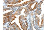 The image on the left is immunohistochemistry of paraffin-embedded Human esophagus cancer tissue using CSB-PA437416(F2 Antibody) at dilution 1/20, on the right is treated with synthetic peptide. (Original magnification: 
