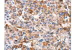 The image on the left is immunohistochemistry of paraffin-embedded Human liver cancer tissue using CSB-PA437479(EPO Antibody) at dilution 1/15, on the right is treated with synthetic peptide. (Original magnification: 
