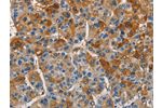 The image on the left is immunohistochemistry of paraffin-embedded Human liver cancer tissue using CSB-PA437759(CST4 Antibody) at dilution 1/60, on the right is treated with fusion protein. (Original magnification: 