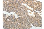 The image on the left is immunohistochemistry of paraffin-embedded Human liver cancer tissue using CSB-PA437890(ABCB11 Antibody) at dilution 1/25, on the right is treated with synthetic peptide. (Original magnification: 