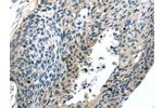 The image on the left is immunohistochemistry of paraffin-embedded Human esophagus cancer tissue using CSB-PA437965(BOK(BH3 domain) Antibody) at dilution 1/20, on the right is treated with synthetic peptide.