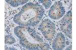 The image on the left is immunohistochemistry of paraffin-embedded Human colon cancer tissue using CSB-PA437981(COL2A1 Antibody) at dilution 1/15, on the right is treated with fusion protein. (Original magnification: 
