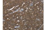 The image on the left is immunohistochemistry of paraffin-embedded Human ovarian cancer tissue using CSB-PA437995(FASTKD1 Antibody) at dilution 1/50, on the right is treated with fusion protein. (Original magnification: 