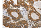 The image on the left is immunohistochemistry of paraffin-embedded Human colon cancer tissue using CSB-PA438009(ATG4A Antibody) at dilution 1/45, on the right is treated with synthetic peptide. (Original magnification: 